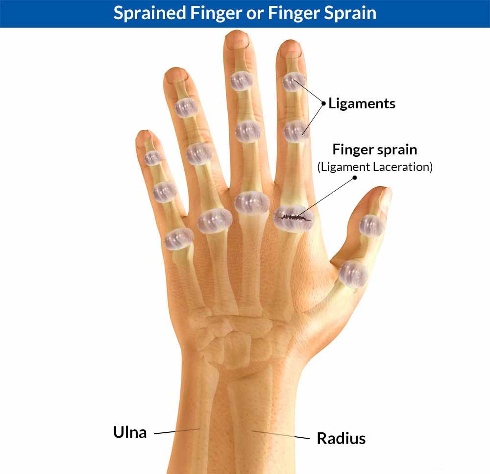 cactus-thorn-in-between-knuckles-pain-and-swelling-i-have-had